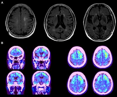 Alterations in cognitive function and blood biomarkers following transcranial direct current stimulation in patients with amyloid positron emission tomography-positive Alzheimer’s disease: a preliminary study